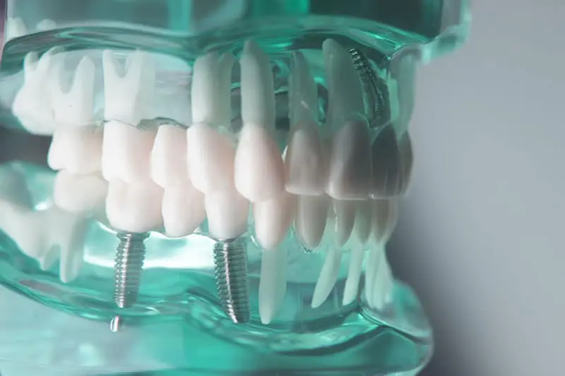 زراعة الأسنان في تركيا أهم العيادات وكم التكاليف